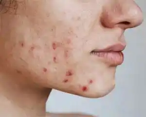 acne treatment
