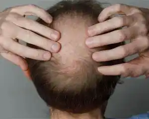 Hair Loss Treatment