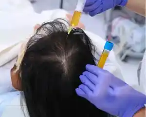 PRP Hair Treatment