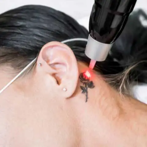 Tattoo Removal Specialist Doctor in South Delhi